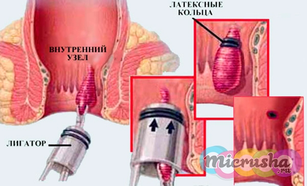 лигирование геморроидальных узлов латексными кольцами